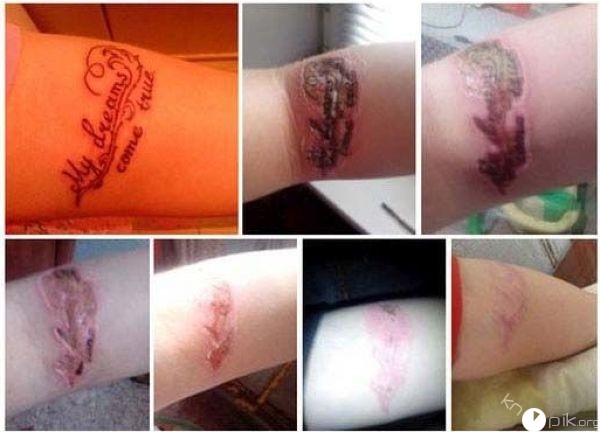 Последствия выведения татуировок чистотелом